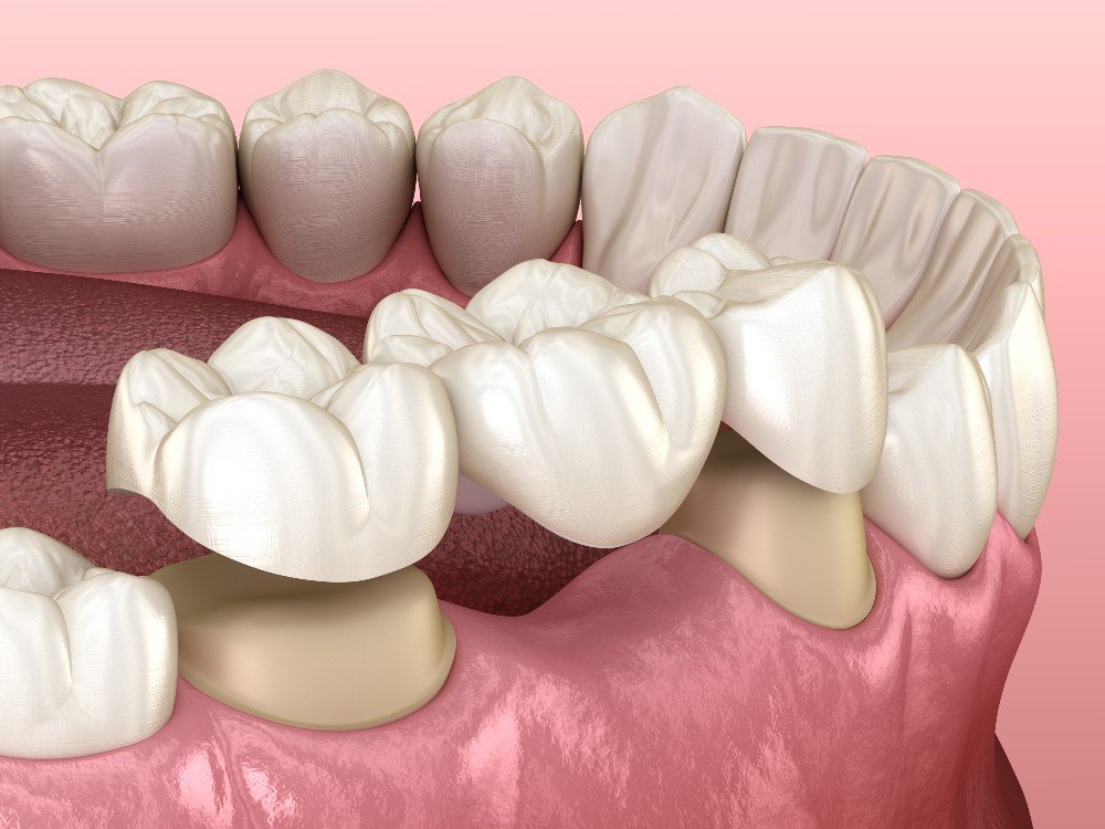 dental-bridge-treatments-for-missing-teeth