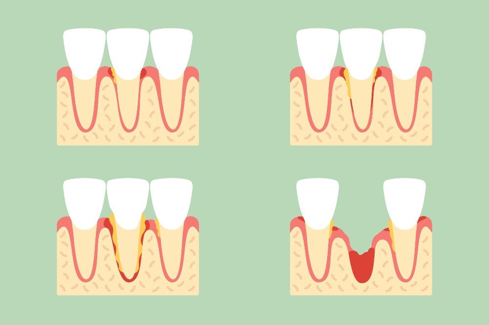 gum-disease