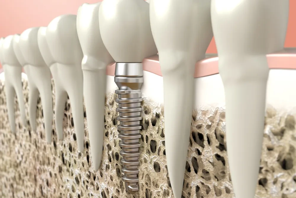 Single-dental-implant