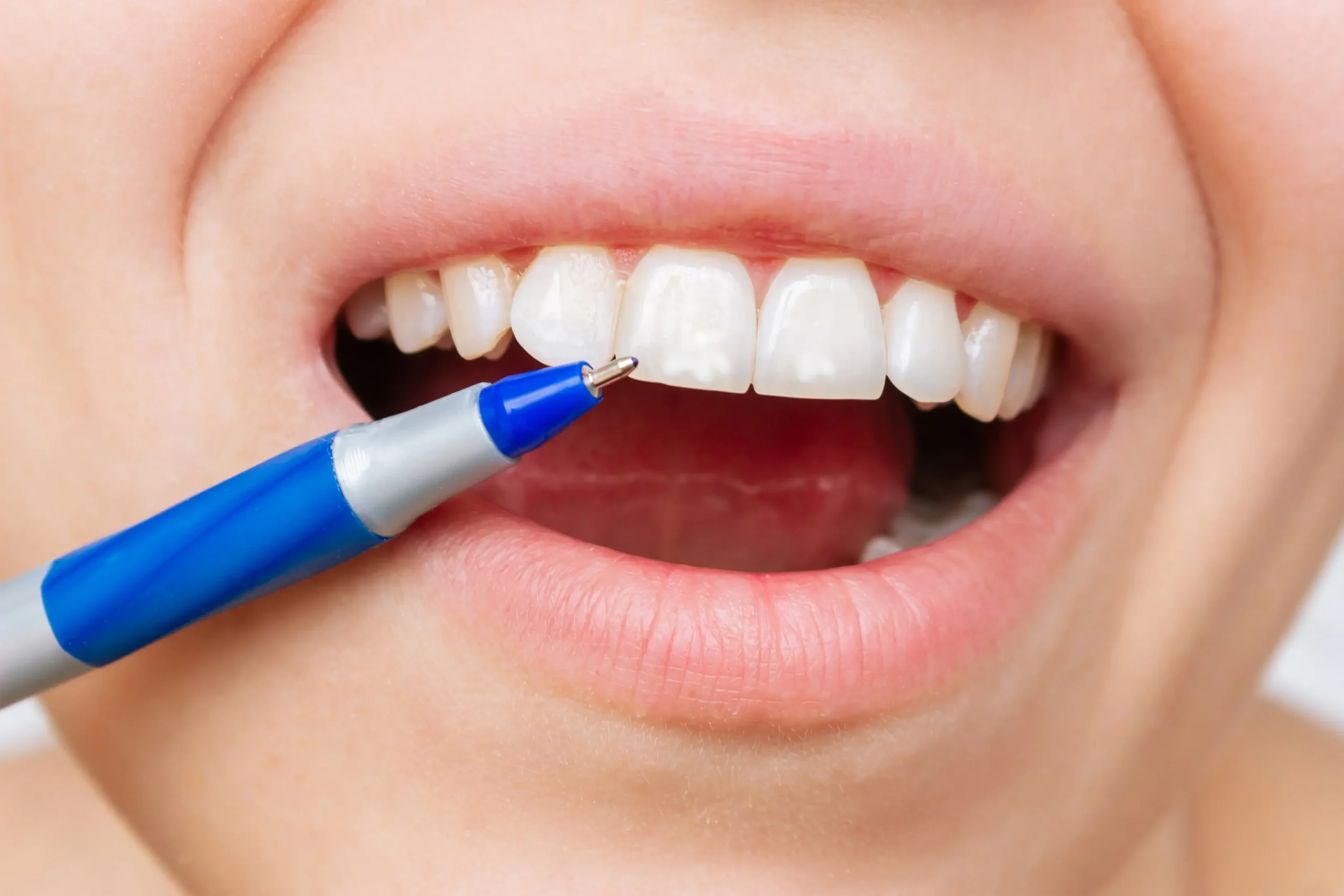 person smiling with a pen points to their teeth