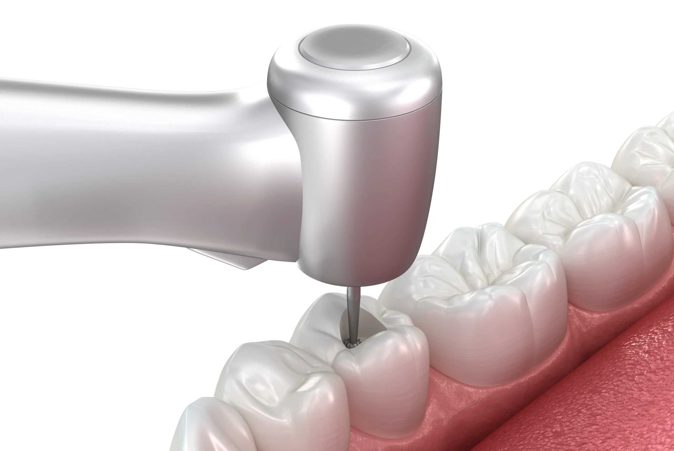 How Do I Know If I Need a Root Canal or a Filling?