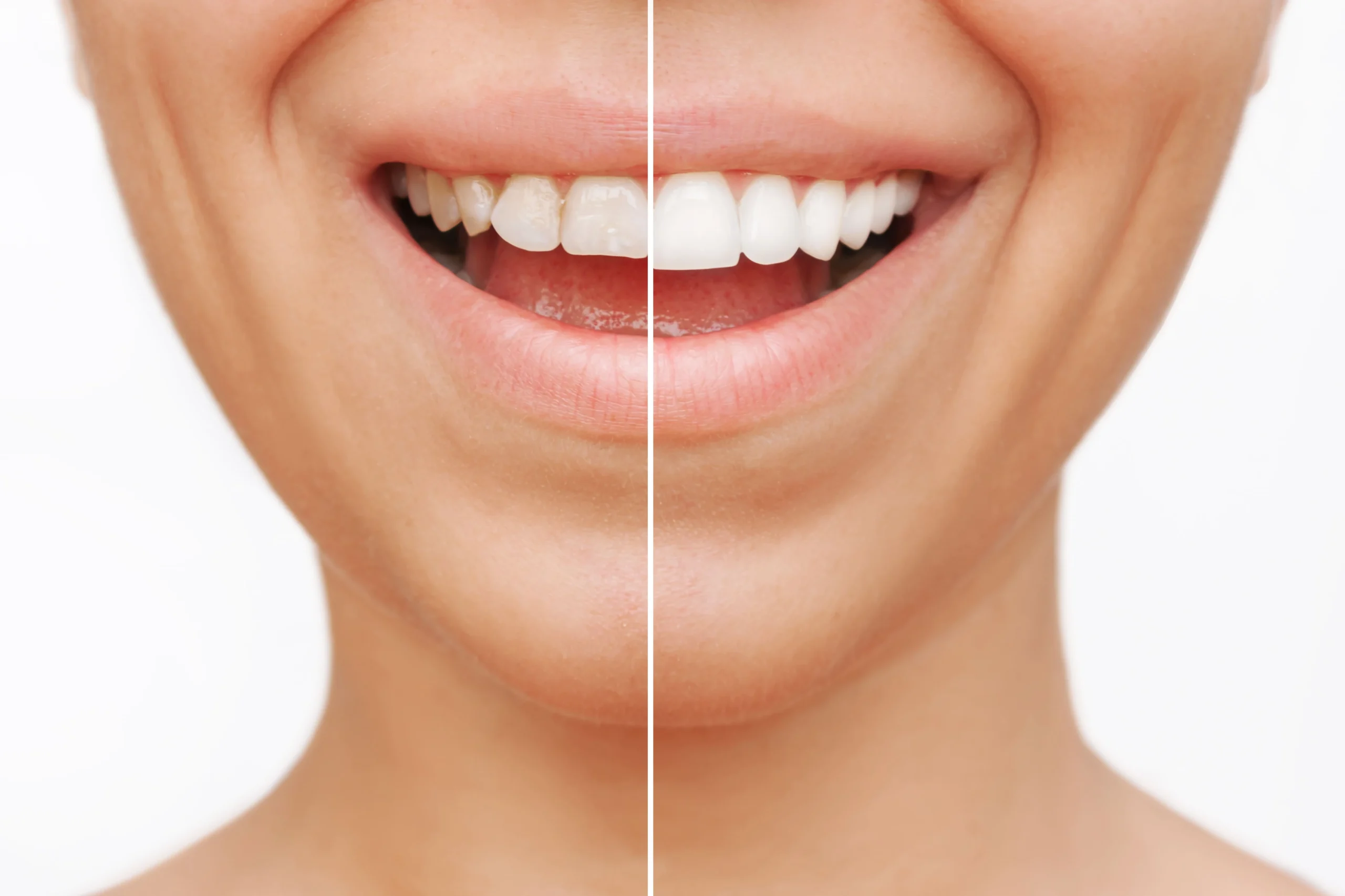 Are Veneers Bad for Your Teeth?